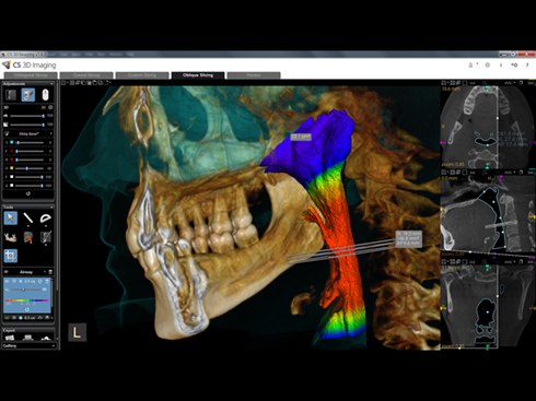 CS Airway